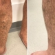 Before + After Varicose Vein Treatment