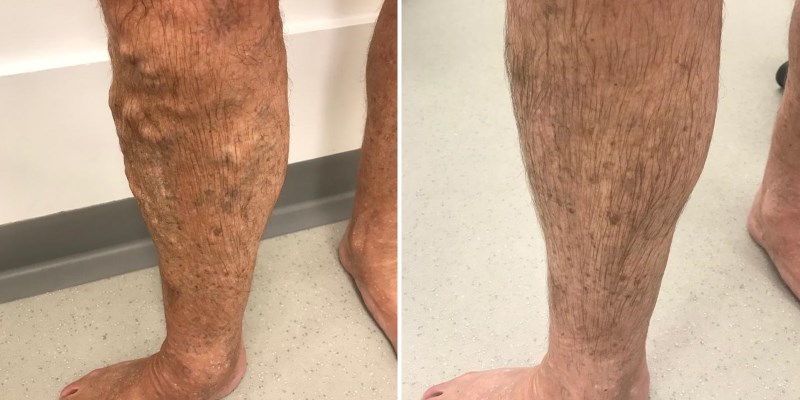 Before + After Varicose Vein Treatment