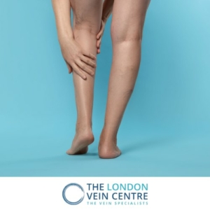 Leg thread vein treatment