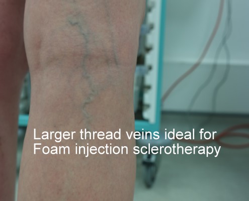 foam sclerotherapy