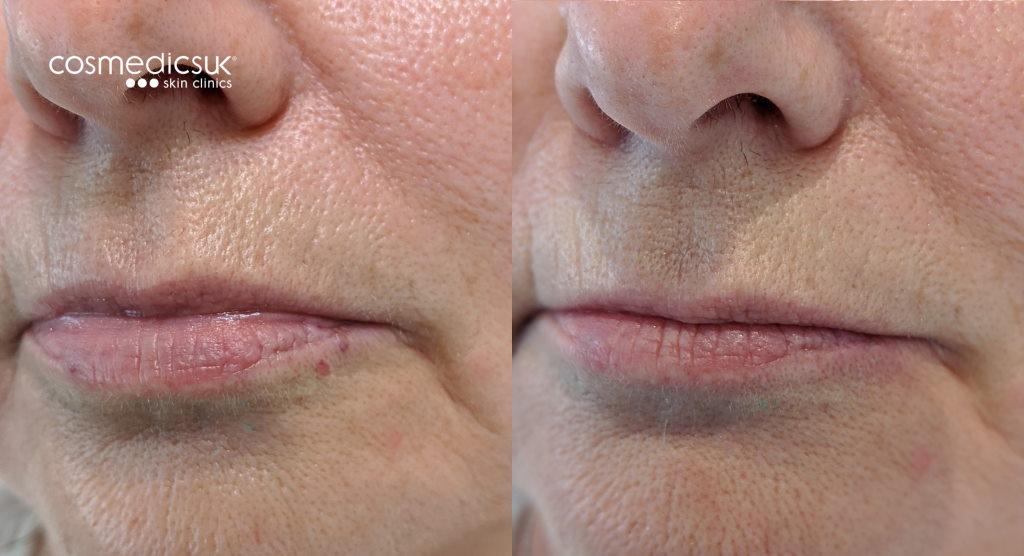 Before and after venous lake laser treatment
