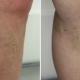london varicose vein treatment before and after