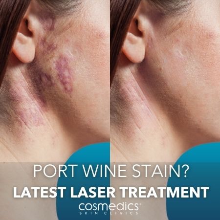 port wine stain laser treatment