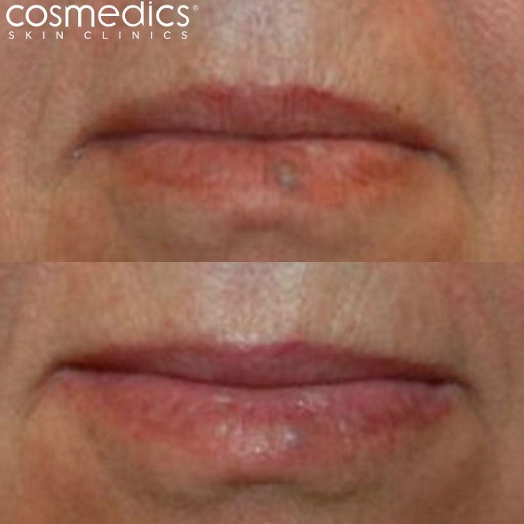 results facial laser thread vein removal harmony