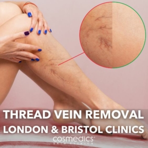 thread vein removal London and Bristol