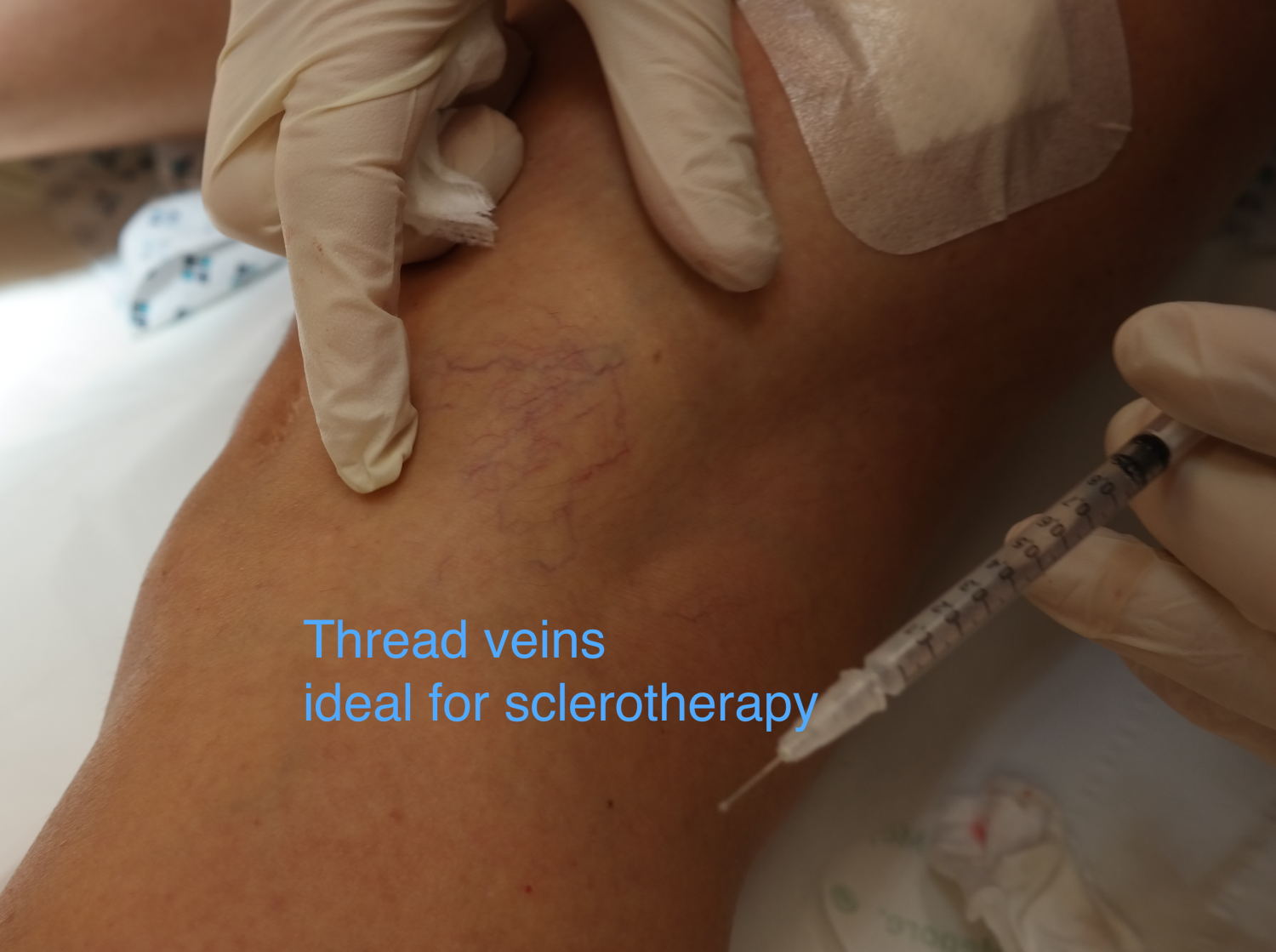 thread veins sclerotherapy