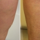 varicose-vein-leg-before-and-after