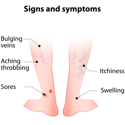 Diagram - Symptoms of Varicose Veins