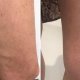 varicose veins thighs before and after
