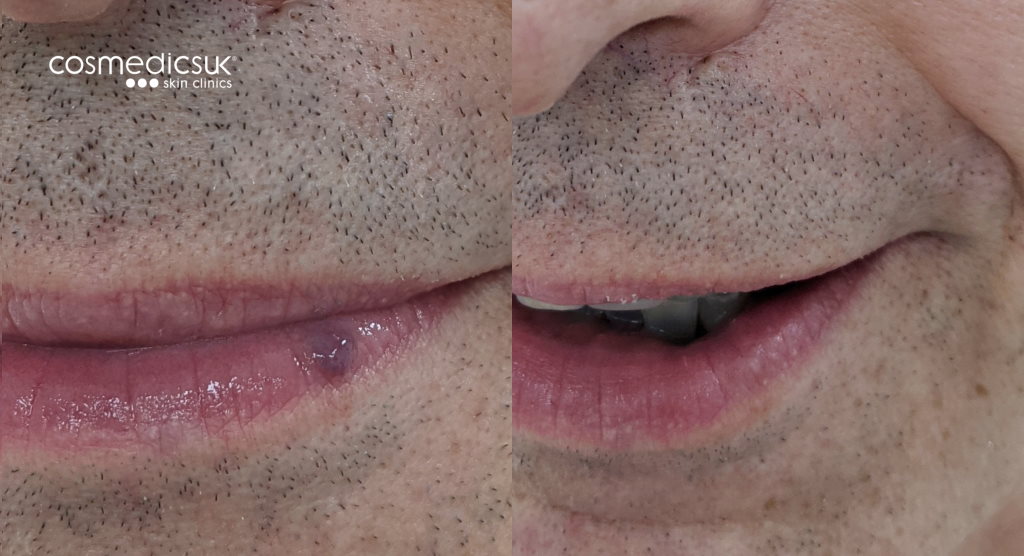 Venous lake before and after results