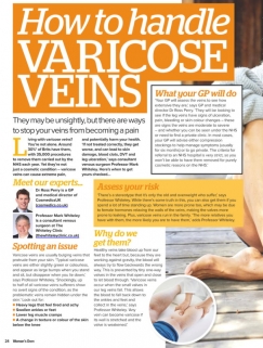 womans own varicose veins